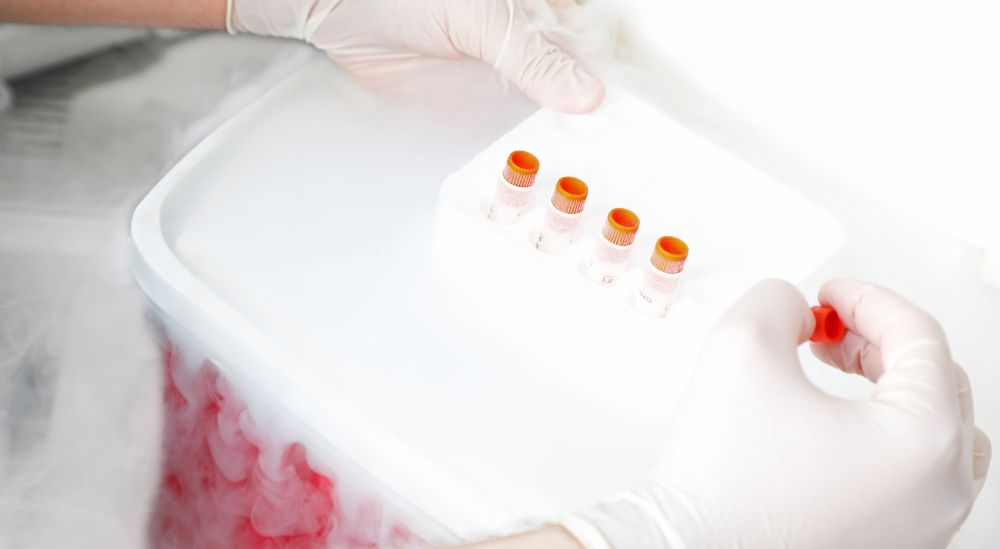 Sperm freezing in Azoury IVF lebanon clinic allows fertility preservation in men Sperm freezing in Azoury IVF lebanon clinic allows fertility preservation in men